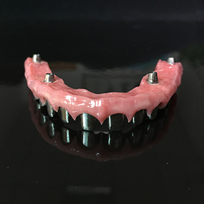 Dental implantın tərifi