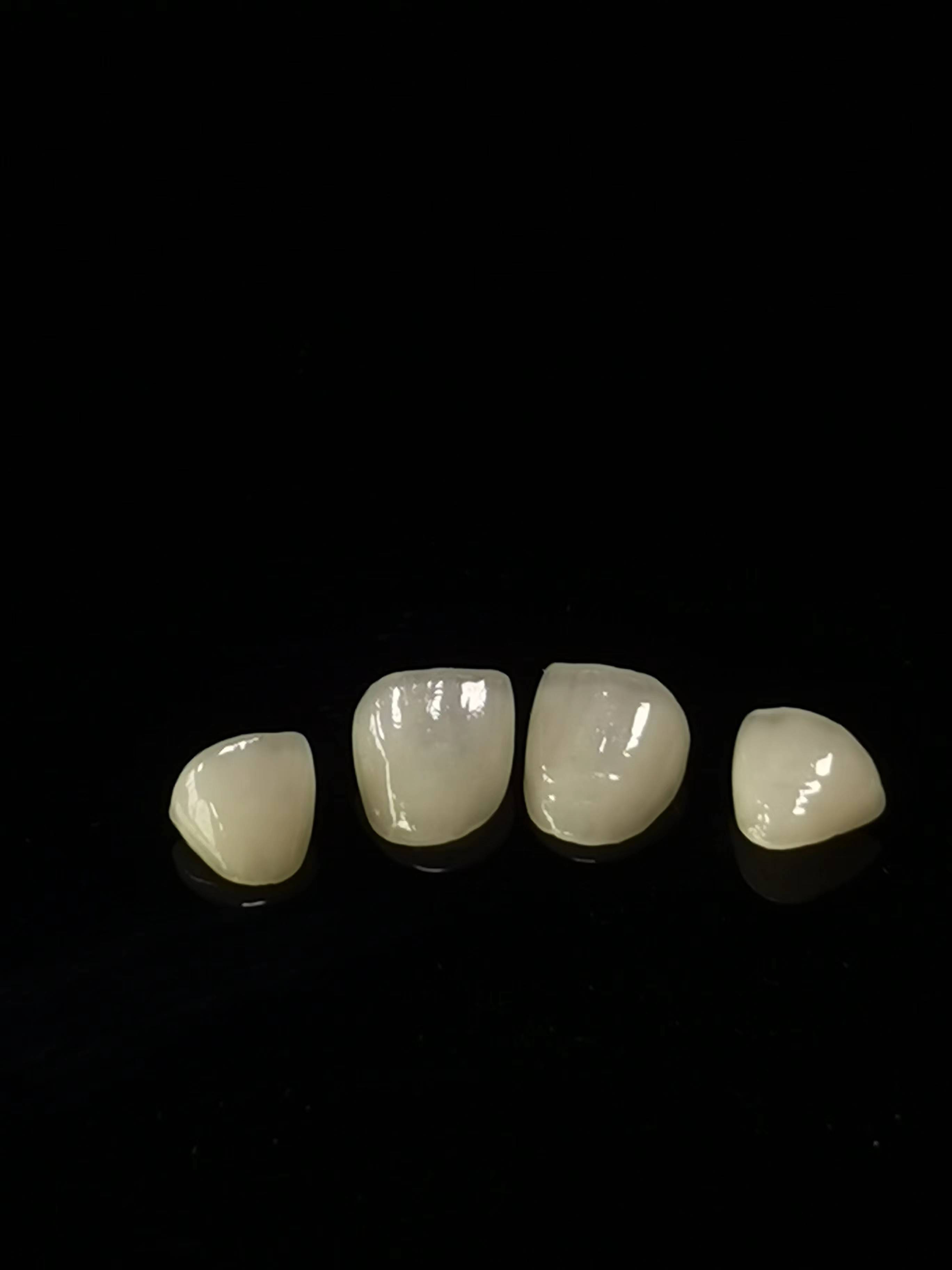 E.max Dental laboratoriya işi