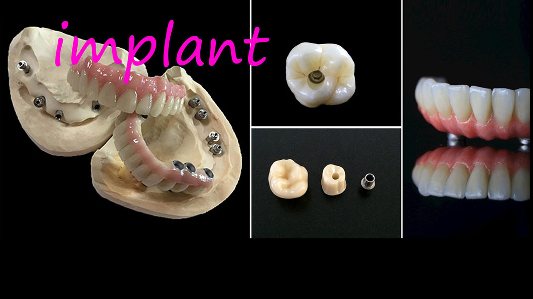Diş İmplantları
