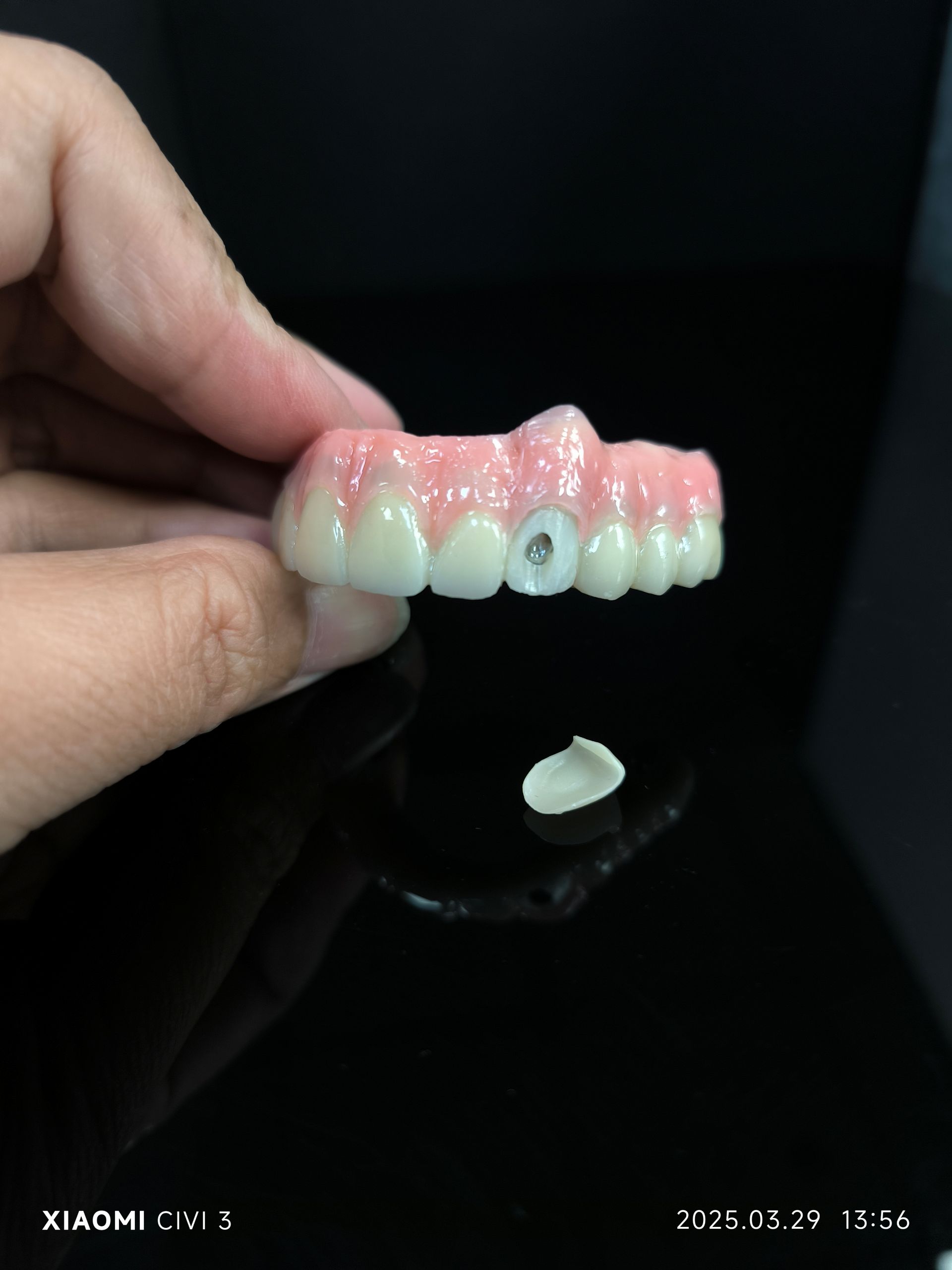 4 hibriddə hamısı - vestibulyar vida çuxuru üçün hibrid zirkoni körpü həlli