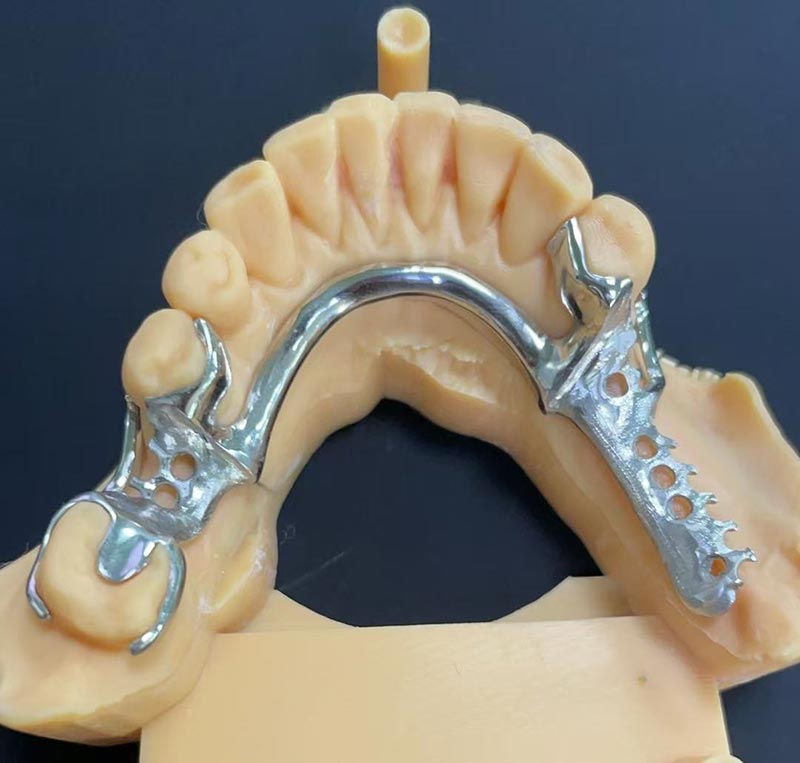 Kobalt-Xrom Çərçivəsinin Üstünlükləri (Co Cr Çərçivəsi)