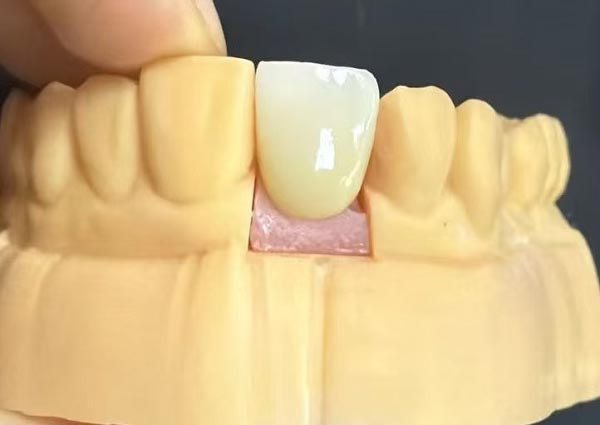 Dişlər arasındakı boşluqlar düzəldilə bilər—Düz dişlər ən cəlbedicidir!