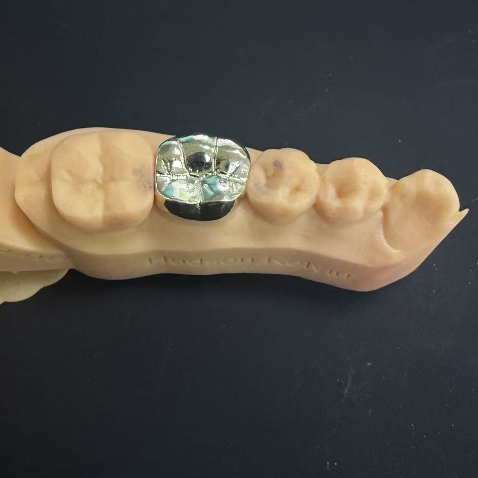 Qızıl Taclar: Ömürlük Diş Bərpası üçün Qiymətli Metal Seçimi