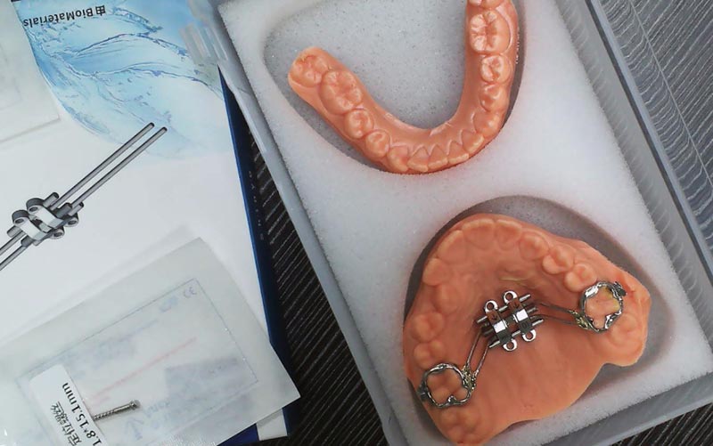 WM Dental Lab ilə MSE Skeletal Genişlənməsini anlayın