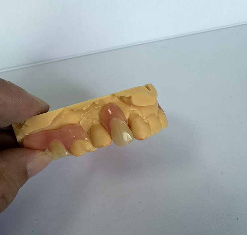 WM Dental Lab-da Valplast Partials