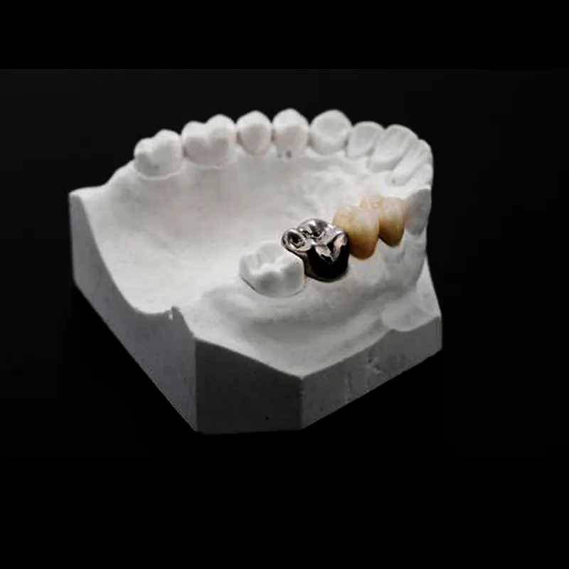 Klinisyenler posterior bərpalar üçün nə vaxt tam metal tac seçməlidirlər?