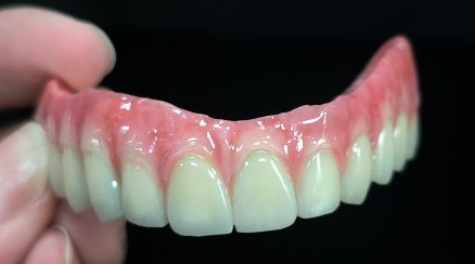 Hamısı 4 hibrid - Malo körpüsü titan quruluşu üzərində tam zirkon tacları