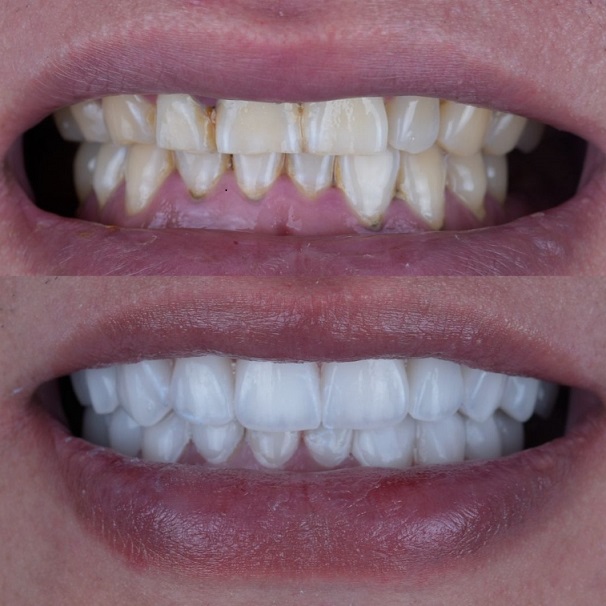 Emax Layered Veneers Estetik Çin Diş Laboratoriyası işi