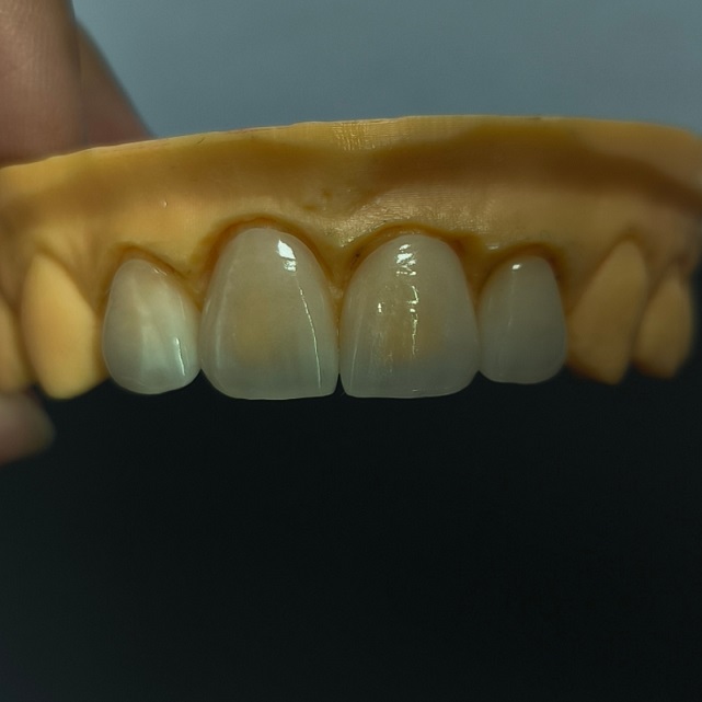 Yüksək Translucent Diş Kaplamaları Layered Emax Veneer