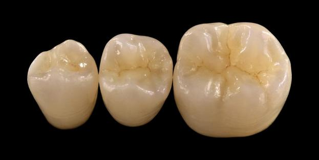 <h2>Stomatologiyada sirkoniya: Göstərişlər, Üstünlüklər və Klinik Mülahizələr</h2>
<p>Zirkonya gücü və davamlılığı ilə geniş şəkildə tanınır. Ən son nəsil sirkon materialları da əhəmiyyətli dərəcədə təkmilləşdirilmiş estetik xüsusiyyətlər təklif edir. Tam keramika bərpasını düşünən xəstələr üçün sirkoniya əsaslı sistemlərin həm göstəricilərini, həm də məhdudiyyətlərini diqqətlə qiymətləndirmək vacibdir.</p>
<p>Bu gün xəstələr getdikcə mükəmməl estetikanı tam funksional performansla birləşdirən bərpa işləri gözləyirlər. Müasir keramika sistemlərinin əksəriyyəti bu gözləntilərə cavab verə bilər, lakin klinik müvəffəqiyyət əsasən düzgün material seçimindən, diş hazırlığından və sementləşdirmə protokollarından asılıdır. Seçim, qırılma müqaviməti, əyilmə gücü, aşınma müqaviməti və uzunmüddətli sabitlik kimi əsas material xüsusiyyətlərinə əsaslanmalıdır. Bu materiallar arasında sirkoniya müasir bərpaedici stomatologiyada ən çox istifadə edilən variantlardan birinə çevrilmişdir.</p>
<h3>Niyə sirkoniya seçməlisiniz?</h3>
<p>Zirkoniya müstəsna gücü və uzunmüddətli davamlılığı ilə qiymətləndirilir. Müasir sirkoniya daha qeyri-şəffaf və daha az estetik olan əvvəlki nəsillərdən əhəmiyyətli dərəcədə fərqlənir. Bu gün CAD/CAM texnologiyası təkmilləşdirilmiş optik xassələrə malik sirkoniya bərpalarının dəqiq istehsalına imkan verir.</p>
<p>Bərpa işləri aşağıdakı kimi tərtib edilə bilər:</p>
<ul>
<li><strong>Monolit sirkoniya:</strong>Arxa taclar və körpülər üçün idealdır, yüksək möhkəmlik və davamlılıq təklif edir.</li>
<li><strong>Qatlı sirkoniya:</strong>Ağızın müxtəlif nahiyələrində uzun müddətli bərpalar da daxil olmaqla təkmilləşdirilmiş estetika tələb edən hallar üçün uyğundur.</li>
</ul>
<p>Bükülmə gücü növündən asılı olaraq dəyişir, yüksək şəffaf sirkoniyada təxminən 590 MPa-dan monolit formalarda 1400 MPa-a qədər dəyişir. Zirkon restavrasiyaları öz-özünə yapışan qatran sementləri və ya qatranla dəyişdirilmiş şüşə ionomer sementlərdən istifadə etməklə sementlənə bilər.</p>
<h3>Zirkon materialının seçimində əsas amillər</h3>
<p>Tam keramika bərpası üçün sirkoniyanı nəzərdən keçirərkən, klinisyenler bir neçə kritik faktoru qiymətləndirməlidirlər:</p>
<ul>
<li>Qalan diş quruluşu</li>
<li>Ağız boşluğunda yerləşmə (estetik zonaya qarşı funksional zona)</li>
<li>Bruksizm kimi parafunksional vərdişlərin olması</li>
<li>Bitişik təbii dişlərin şəffaflığı</li>
<li>Altda yatan diş quruluşunun rəngi və vəziyyəti</li>
</ul>
<p>Estetik zona adətən ön dişləri əhatə edir, baxmayaraq ki, bəzi xəstələrdə təbəssüm xətti və üz dinamikasından asılı olaraq birinci azı dişinə qədər uzana bilər. Funksional zonaya ümumiyyətlə oklüzal qüvvələrin əhəmiyyətli dərəcədə yüksək olduğu premolar və azı dişləri daxildir.</p>
<h3>Funksional Zona Tətbiqləri</h3>
<p>Posterior bölgələrdə oklüzal qüvvələr diqqətlə nəzərdən keçirilməlidir. Zirkoniya ənənəvi PFM bərpasına əla alternativdir, xüsusən də bərpaedici sahəsi məhdud olan hallarda. Müasir monolit sirkoniya yüksək gücü saxlamaqla, funksional ucları və marjinal silsilələr də daxil olmaqla oklüzal anatomiyanın tam kontur dizaynına imkan verir.</p>
<p>Mövcud sübutlar göstərir ki, monolit sirkoniya qırılma və aşınmaya qarşı əla müqavimətinə görə arxa taclar və çox vahidli körpülər üçün yaxşı uyğun gəlir. Yapışqan texnikası və hazırlıq dizaynındakı irəliləyişlər də uzunmüddətli klinik nəticələri yaxşılaşdırmışdır.</p>
<h3>Estetik Zona Tətbiqləri</h3>
<p>Anterior bölgədə bərpalar təbii diş rəngini, şəffaflığı və işıq davranışını yaxından təkrarlamalıdır. Litium disilikat kimi materiallar əla estetika təqdim etsə də, onlar daha az möhkəmdir və adətən yapışan yapışma tələb edir.</p>
<p>Zirkoniyanın əsas üstünlüyü onun yüksək estetik performansa nail olmaqla yanaşı şərti sementlənmə qabiliyyətidir. Yüksək şəffaflığa malik və çox qatlı sirkon sistemlərinin inkişafı ilə artıq təbii dişləməni yaxından təqlid edən bərpalar istehsal etmək mümkündür.</p>
<p>Qabaqcıl emal üsulları optik xüsusiyyətləri daha da artırır və işığın ötürülməsinə və görünüşünə təsir edə biləcək qüsurları azaldır.</p>
<h3>Güc və Estetik Birləşdirilmişdir</h3>
<p>Erkən sirkon sistemləri gücə üstünlük verirdi, lakin estetik keyfiyyətdən məhrum idi. Müasir monolit sirkoniya həm gücü, həm də təkmilləşdirilmiş görünüşü uğurla birləşdirərək, onu geniş klinik hallar üçün uyğun edir.</p>
<p>Xüsusilə parafunksional vərdişləri və ya əvvəlki bərpa uğursuzluğu olan xəstələr üçün faydalıdır. Klinik tədqiqatlar yüksək xəstə qəbulunu və aşağı fəsad nisbətlərini göstərir.</p>
<p>Qarşılıqlı dişlərin aşınması ilə bağlı narahatlıqlar daha yeni formulalarla azaldıldı. Yüksək dərəcədə cilalanmış sirkon səthləri aşağı aşındırıcı potensial nümayiş etdirir və bəzi hallarda ənənəvi çini əridilmiş metal bərpalardan daha yumşaq ola bilər.</p>
<h3>Zirkonya İmplantları: İnkişaf etməkdə olan Alternativ</h3>
<p>Titan implantları klinik standart olaraq qalmasına baxmayaraq, sirkoniya implantları metalsız bir alternativ olaraq diqqəti cəlb edir. İlkin dizaynlar əsasən bir hissəli sistemlər idi, lakin iki hissəli sirkon implantları indi protezin elastikliyini yaxşılaşdırmağa imkan verir.</p>
<p>Zirkon implantları, implantın peri-implant toxumalarının potensial boz rənginin dəyişməsi və ya nazik diş əti biotipi kimi estetik narahatlıqların mövcud olduğu hallarda xüsusilə faydalıdır. Nadir titan həssaslığı olan xəstələr üçün də nəzərdən keçirilə bilər.</p>
<p>Bununla belə, sirkoniya implantları hələ nisbətən yenidir və uzunmüddətli klinik məlumatlar titan sistemləri ilə müqayisədə məhdud olaraq qalır.</p>
<h3>Nəticə</h3>
<p>Zirkoniya bərpaedici stomatologiyada mexaniki performans və estetika arasında güclü tarazlıq təklif edən çox yönlü materiala çevrilmişdir. Həm anterior, həm də posterior tətbiqlərdə optimal nəticələr əldə etmək üçün düzgün vəziyyət seçimi və klinik protokollara riayət etmək vacibdir.</p>